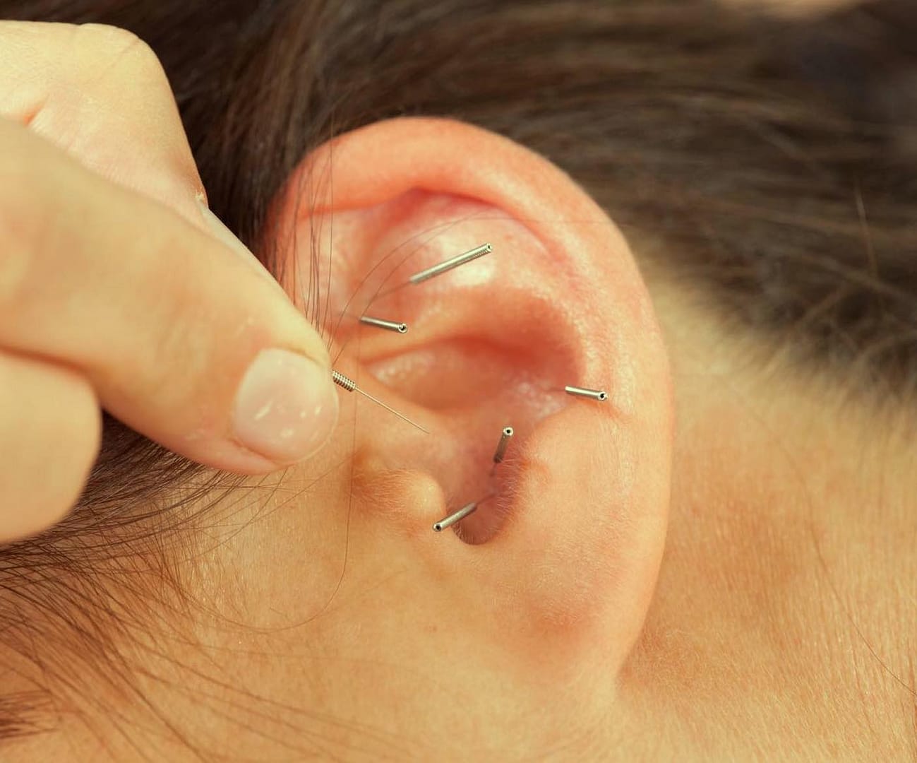 triada health ottawa ear acupuncture