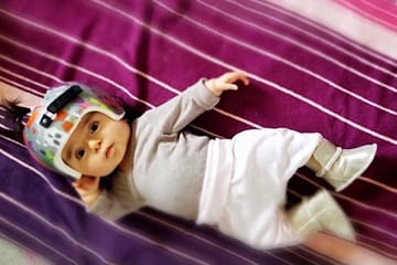 baby girl with helmet to correct flat head shape and torticollis