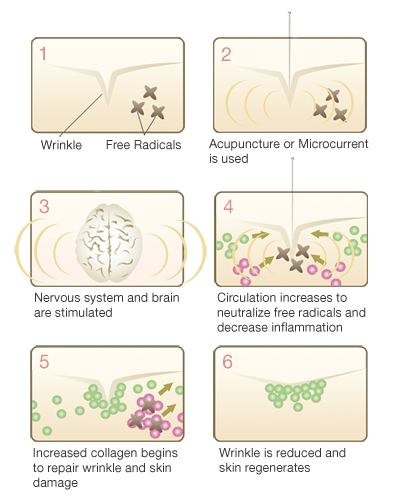 The process of repairing facial wrinkles and signs of aging on the skin. Free radicals neutralized by acupuncture to decrease inflammation and increase collagen.