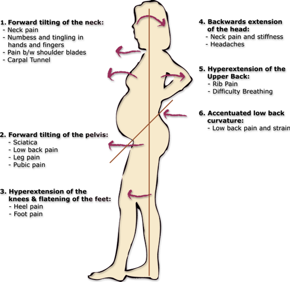 Image of pregnant woman spine and pelvis alignment during pregnancy and how Webster technique can help for breech baby